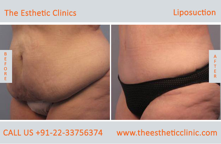 Liposuction Fat Removal Treatment before after photos in mumbai india (5)